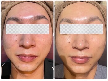 ルタンリッシュオム(Lutan Riche hom)/赤み、毛穴ケア