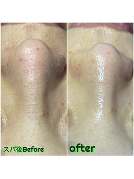 ビービー(BB)/#毛穴洗浄