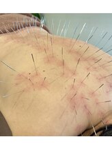 鍼日和/ルート鍼90分　腰痛　肩こり