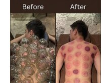 康泰苑鍼灸整体院/強い肩背中のコリにカッピング