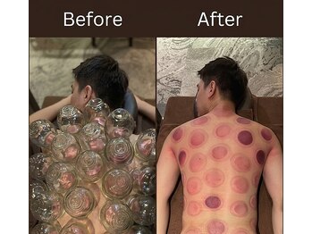 康泰苑鍼灸整体院/強い肩背中のコリにカッピング