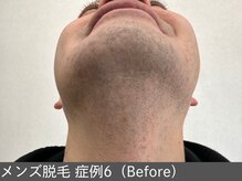オアシスラグーン(OASIS LAGOON)/メンズ脱毛（症例6 before）