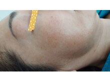 麻謝/純正レチノール２　Ａｆｔｅｒ