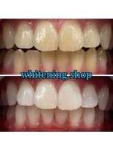 ホワイトニングショップ 長崎時津店/Before&After美白ホワイトニング