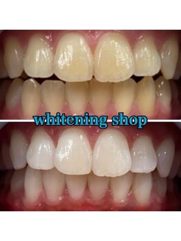 ホワイトニングショップ 長崎時津店/Before&After美白ホワイトニング