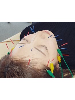 鍼灸施術を受けたい