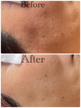 サロン ジジ(salon JiJi)/白玉乳酸ピーリング