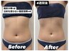 【モニター募集!】1～2パーツ☆脂肪分解×2.針を使わない脂肪分解×4 ￥39800