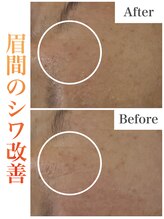 ミムー/before／after