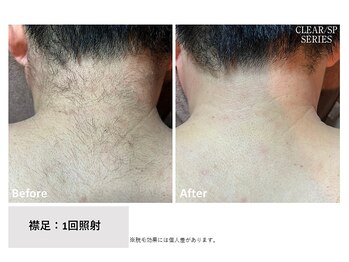 ザ エッセンシャル 碧南(THE Essential)/メンズ 襟足脱毛(Mパーツ)