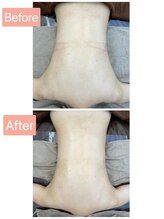 ブレス 夙川店(Bless)/Before After(背中)