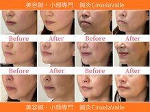 シルエラバレ(CiruelaValle)