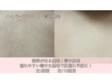 オーシャンブルー 時津店(OCEAN BLUE)/結果が出る脱毛！背中脱毛