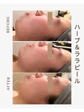 ツヤハダコガオ 千葉店/before⇒afterハーブピーリング