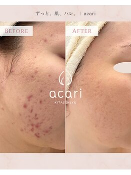 アカリ(acari)/二人三脚で肌改善を目指します