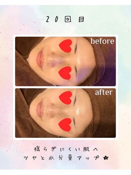 リリアン(lirien)/毛穴/毛穴ケア/毛穴洗浄/駒込