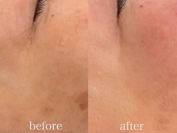 アリス(ALICE)/ハーブピーリング