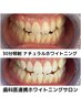 卒業生・新社会人向けプラン【30分照射1,000円】歯の白さで好印象GET！