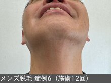 オアシスラグーン(OASIS LAGOON)/メンズ脱毛（症例6 施術12回）