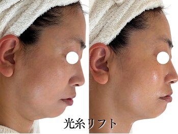 ボディメイキング キキ(Bodymaking KIKI)の写真/【切らない！打たない！最新リフトアップ】韓国で人気の光糸リフトでたるみをググっと引き上げる！◎