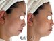 ボディメイキング キキ(Bodymaking KIKI)の写真/【切らない！打たない！最新リフトアップ】韓国で人気の光糸リフトでたるみをググっと引き上げる！◎