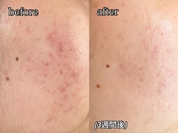 コム(comme39)/肌荒れも徹底解消☆