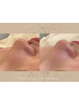 毛穴ケアをしたい