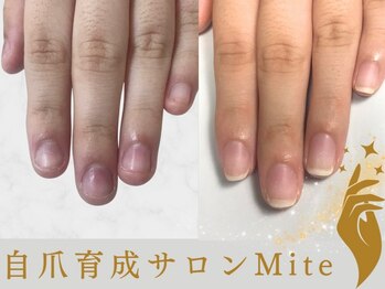 ミテ(Mite)の写真/自爪を健やかに育てる高技術サロン■様々なお悩みにご対応《フィルイン/パラジェル/深爪》