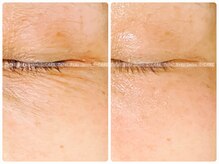 エスケア(S-CARE)/シワ改善には光フェイシャル☆