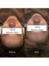 エレナ(Elena)/陶肌トリートメント