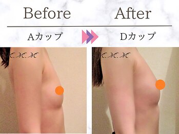 メディカルサロン エム エム エム 大阪梅田グランドサロン(M.M.M)/【バストアップ例】　A→Dカップ