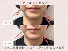 エステサロン プラスエー(+A)/ヒアルロン酸導入　