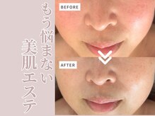 リボーン(Reborn)/ダクトピール1回