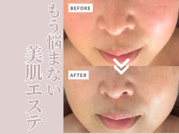 リボーン(Reborn)/ダクトピール1回