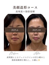 エフリア 大垣(F.lia)/不要な脂肪を燃焼すっきり小顔に