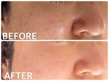 ハーブピーリング 恵比寿/ニキビ/毛穴/くすみ