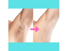 徐々に毛量が少なくなります。脱毛の効果を実感していただけます