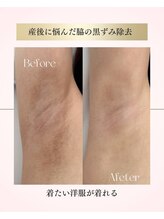 ソイ(Soi)/ワキの黒ずみもローマピンクで♪