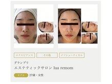 まりも化粧品店/ホワイトスノーピール