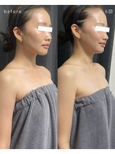 レクシア(LEXIA)/小顔ケア症例｜PRO LIFT 6回目