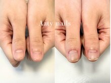 アーティネイルズ(Aaty Nails)/【深爪矯正】ハンド