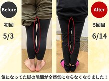 スロース鍼灸整体院(SLOTH鍼灸整体院)/О脚の改善例