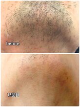 メンズガーデン(men's Garden)/ヒゲ脱毛効果