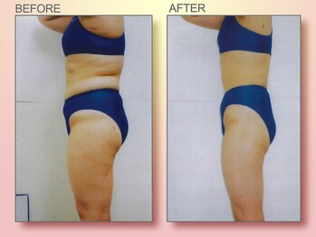 ジュリア オージェ 梅田店/ビフォーアフター(脂肪燃焼)