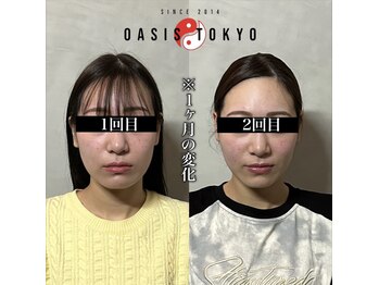 オアシストウキョウ 表参道(OASIS TOKYO)/施術回数：1回