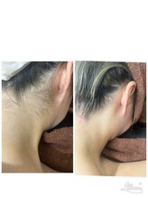 アトレ(ATTRAIT)/うなじ脱毛