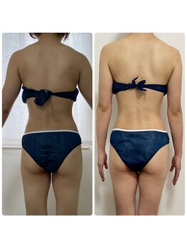 エステサロンブランシュ(Esthe salon Blanche)/ハイパーナイフで肩こりケア