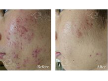 カノン(Kanon.)/リベルハーブピーリング