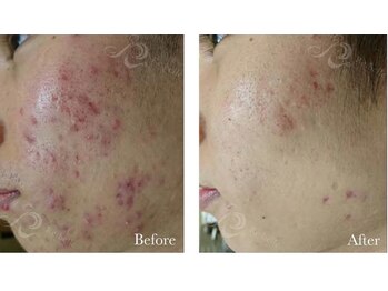 カノン(Kanon.)/リベルハーブピーリング