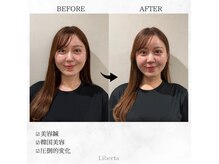 リベルタ鍼灸整骨院 なんば店(Liberta鍼灸整骨院)の雰囲気(圧倒的Before/After小顔効果を実感頂いております。小顔/美容鍼)